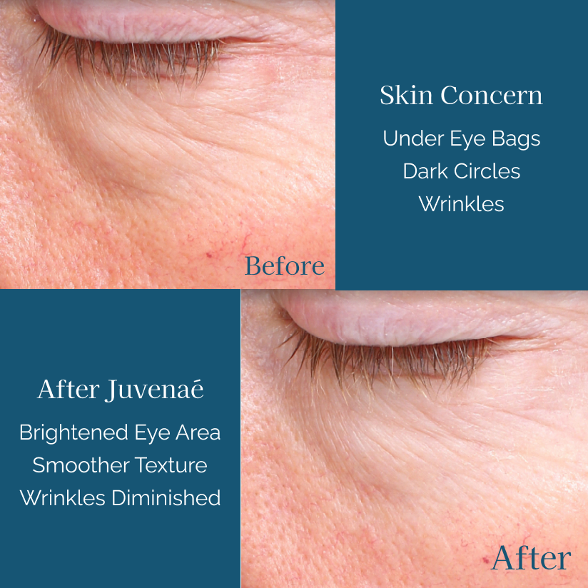 Eye Treatment Juvenaé Skincare